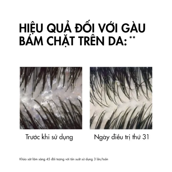 Dầu Gội Vichy Dercos Anti Dandruff Sạch Gàu Cho Da Đầu Dầu, Ngứa 200ml - Hình ảnh 5